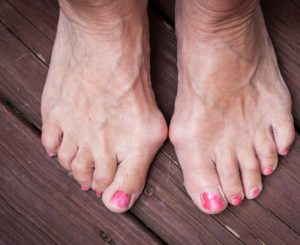 Bunions