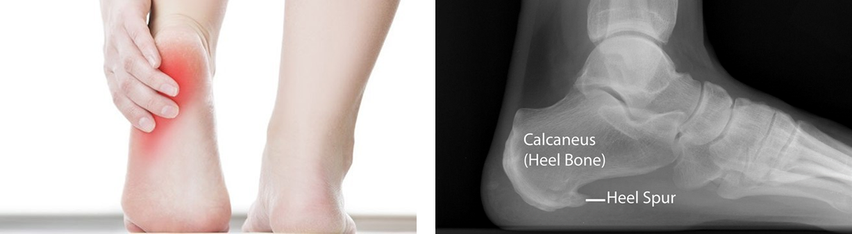 What Are Heel Spurs? 